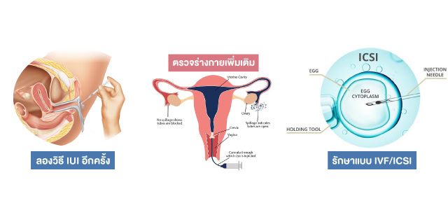 รักษาด้วยวิธี IUI Beyond ivf มีลูกยากอยากมีลูก มีลูกแฝด ทำกิ๊ฟท์ IVF IUI ICSI ศูนย์รักษามีบุตรยาก