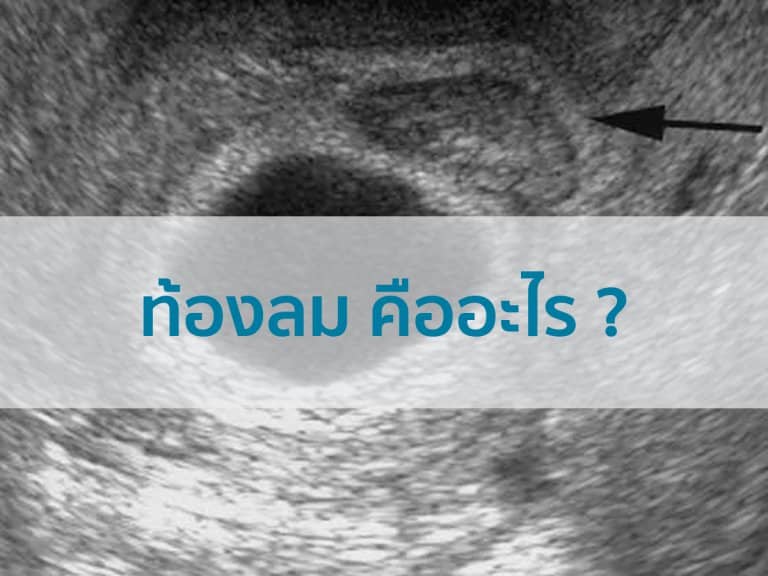 ท้องลม ภาวะท้องลม ท้องลมคืออะไร Beyond IVF 1