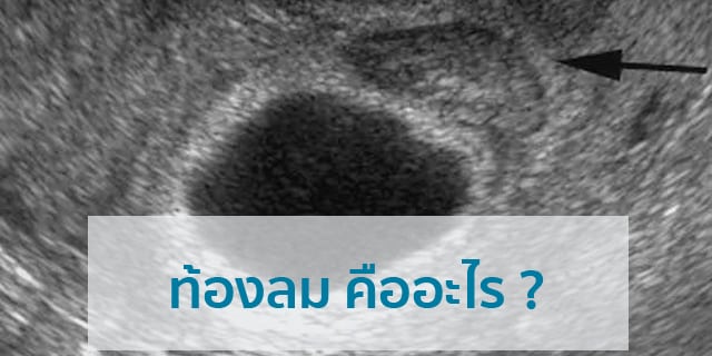 ท้องลม (Blighted Ovum) ภาวะท้องลม ท้องลมคืออะไร Beyond IVF