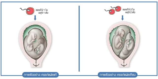 IVF ICSI มีลูกแฝด มีลูกยาก อยากมีลูก Beyond IVF