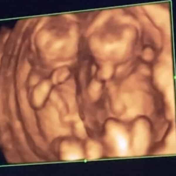 นักร้องปีโป้เสือเล่นไฟ มีลูกแฝด รีวิวลูกแฝด ที่ Beyond IVF