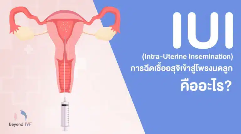 IUI คืออะไร? ราคาเท่าไหร่? คนมีลูกยากควรรู้ เพิ่มโอกาสมีลูก