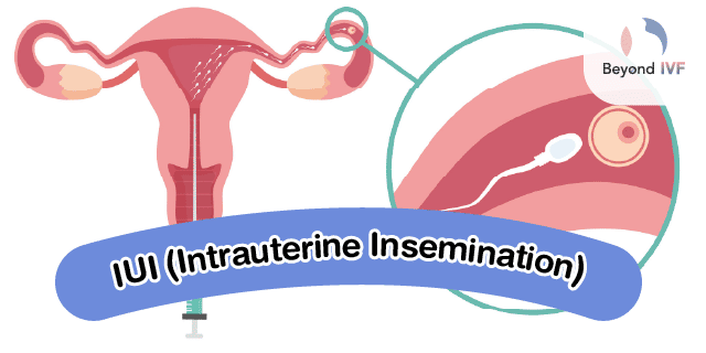 Infertility Treatments