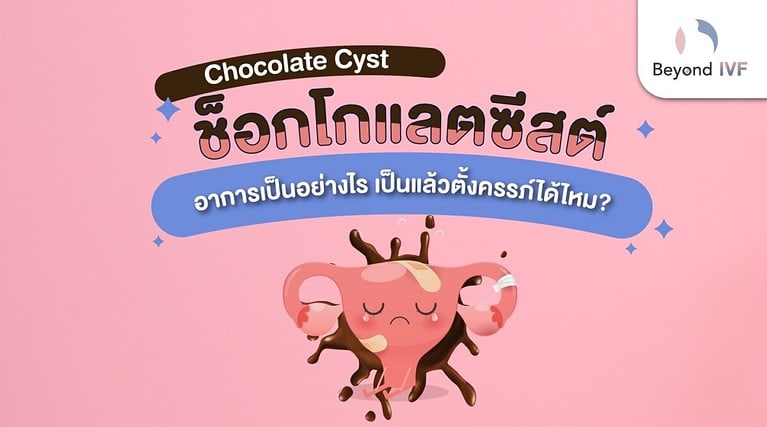 ช็อกโกแลตซีสต์ อาการเป็นอย่างไร หายเองได้ไหม ท้องได้หรือเปล่า?