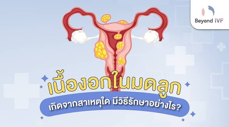 ผ่าตัดเนื้องอกมดลูก